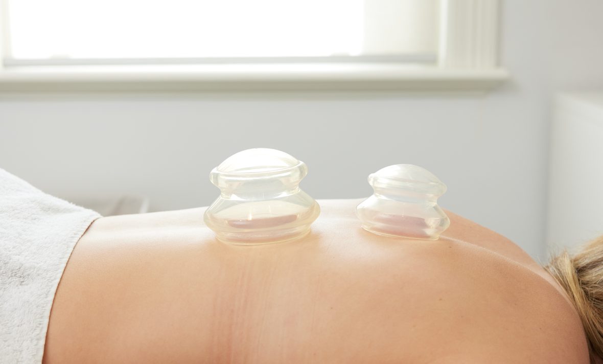Cupping