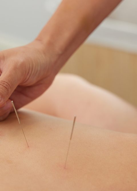 Dry-needling