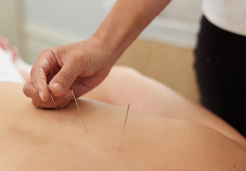 Dry Needling